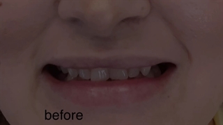 بهترین ایمپلنت و لمینت دندان (دکتر بهمن پوراقدم)02122220000