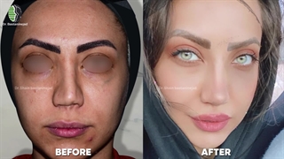 جراحی زیبایی بینی ثانویه | دکتر باستانی نژاد