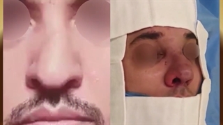 جراحی بینی گوشتی با انحراف شدید