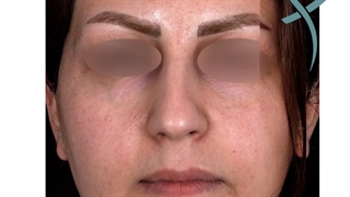 نمونه جراحی بینی مراجعه کننده‌ عزیزمون