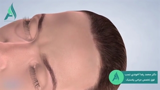انیمیشن لیفت ابرو