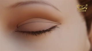 آیا جای بخیه عمل بلفاروپلاستی میماند؟| دکتر تولیت