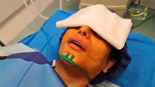 تزریق چربی به صورت توسط دکتر تولیت