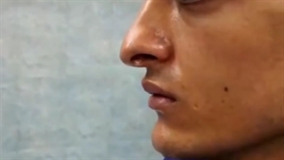بینی غضروفی با افتادگی زیاد