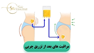 ✅محل برداشت چربی برای پیوند