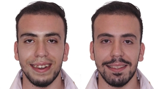 ارتودنسی بدون جراحی فک | دکتر داودیان