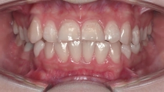 ارتودنسی و کامپوزیت دندان | دکتر داودیان