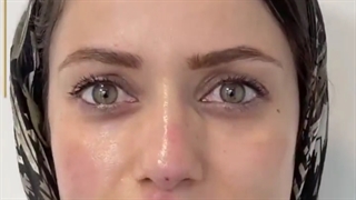 اصلاح فرم بینی با تزریق ژل
