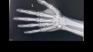 شکستگی متاکارپ دست