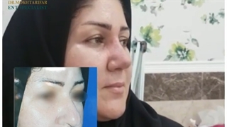 یک ماه پس از جراحی زیبایی در بینی با پوست بسیار ضخیم.