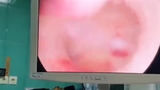 هیستروسکوپی بررسی حفره رحم و برداشت پولیپ قبل از انتقال جنین در سیکل ivf