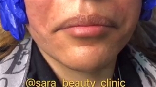 تزریق ژل گونه