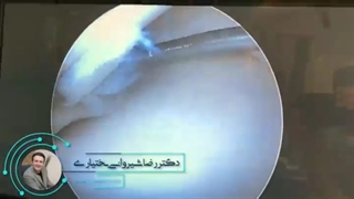 ترمیم منیسک| دکتر شیروانی بختیاری