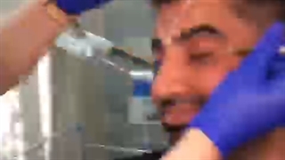 بوتاکس پیشانی با روش جدید