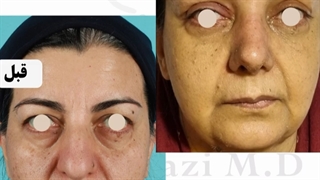 جراحی همزمان بینی گوشتی ، لیفت پیشانی و پلک بالا