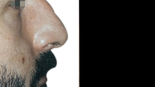 فیلم واقعی جراحی بینی مردانه