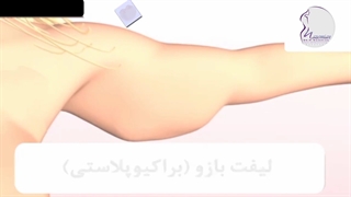 انیمیشن جراحی لیفت بازو