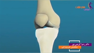 تعویض مفصل زانو