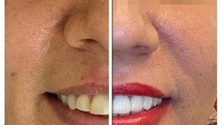 لمینیت دندان