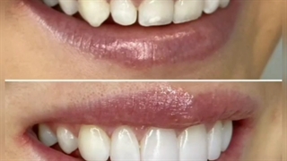 نمونه کار ونیز کامپوزیت