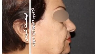 جراحی لیفت گردن
