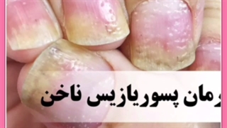 پسوریازیس ناخن چیست و چگونه آن را درمان کنیم؟