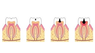 هزینه درمان پوسیدگی دندان چقدر است؟ | کلینیک سیمادنت