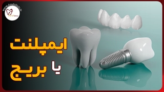 بهترین روش برای جایگزین کردن دندان از دست رفته چیست؟ | عارف کلینیک