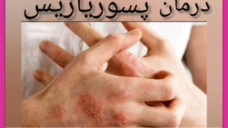 همه آنچه باید درباره پسوریازیس و درمان آن بدانید
