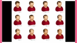 درمان ریزش موی ژنتیکی یا ارثی مردان و انواع الگوی طاسی مردانه