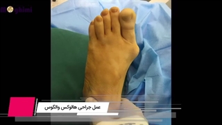 ⭕عمل جراحی هالوکس والگوس⭕