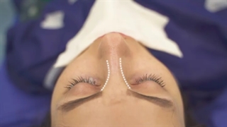 جراحی بینی به سینک نیمه فانتزی