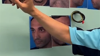 نتیجه عمل رینوپلاست