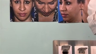 نمونه عمل رینوپلاستی