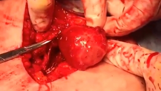 فیلم بدون سانسور خارج کردن تومور