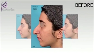 نمونه جراحی بینی دکتر کامران بابابی