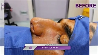 نتیجه عمل زیبایی بینی در آقایان