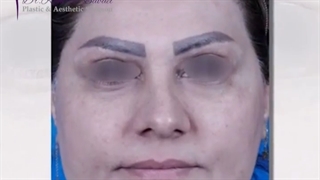 قبل و بعد از جراحی زیبایی بینی