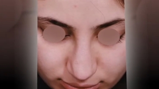 عمل رینوپلاستی در بیمار عزیزمون