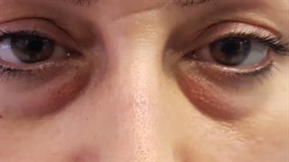 درمان سریع پف پلک