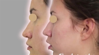 نمونه جراحی زیبایی فک (جلو آوردن چانه)