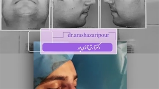 فیلم واقعی عمل بینی