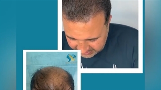 کاشت مو بعد از ۸ ماه