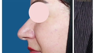 فیلم جراحی بینی گوشتی