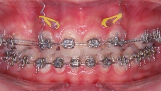 ارتودنسی و ایمپلنت | دکتر داودیان