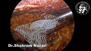 عمل جراحی هرنی بروش TAR