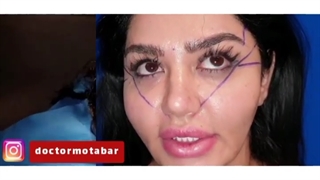فیلم جراحی لیفت آندوسکوپی ابرو و شقیقه