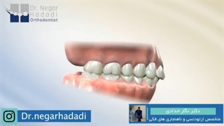 اصلاح نیمرخ صورت با عقب کشیدن فک | دکتر نگار حدادی متخصص ارتودنسی ماموپلاستی