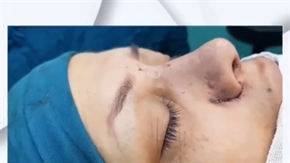 بلافاصله بعد از جراحی زیبایی بینی