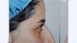 نتیجه جراحی زیبایی بینی
